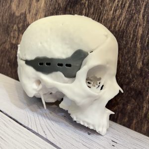 نمونه پرینت سه بعدی فیلامنتی پروتز جمجه